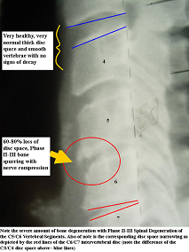 Cervical spine with bone spurs